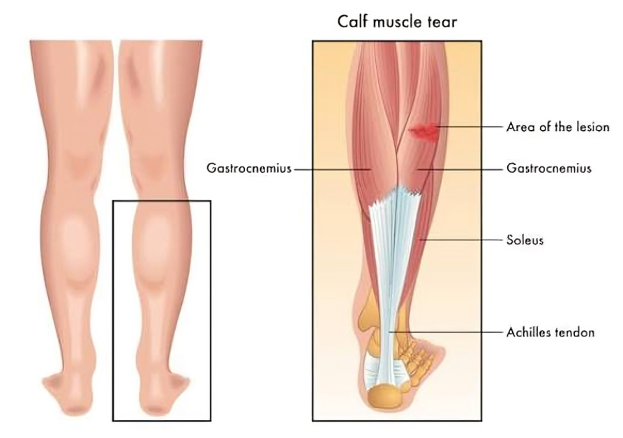 گروه عضلات ساق پا (Calf Muscles)
